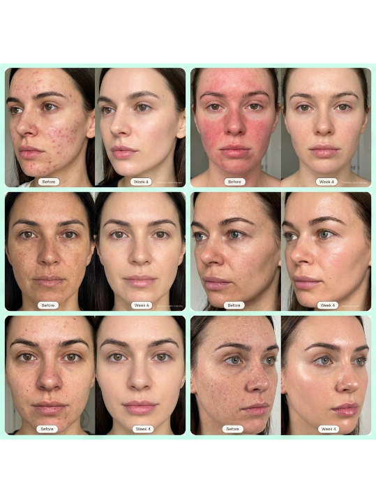 Radiance Face - Pro LED Red Light Therapy Mask
